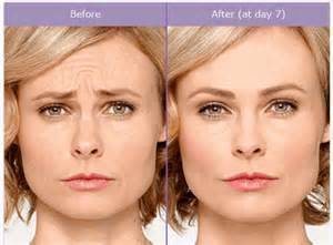 botox images before and after