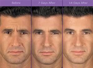 botox before and after man
