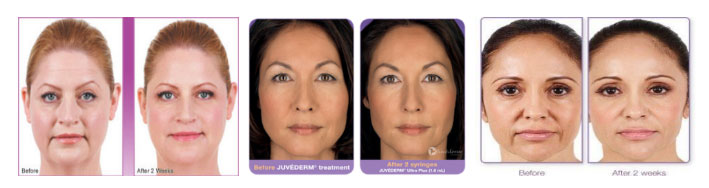 Juvederm results before and after