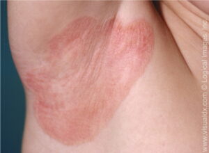 plaque psoriasis image